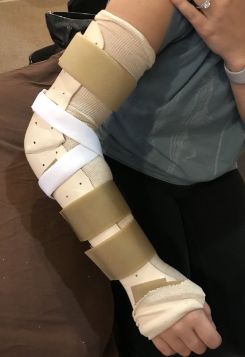 Custom full-arm protective splint