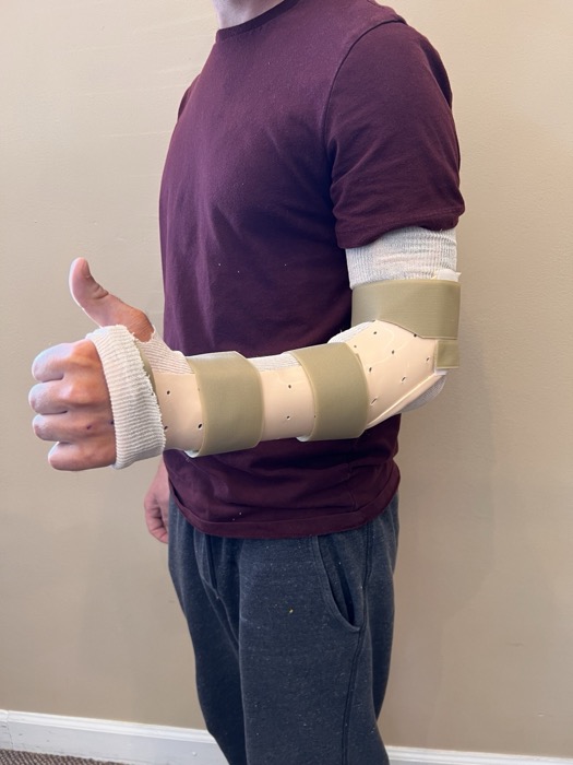 Custom Munster-style elbow splint