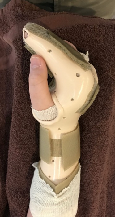 Custom thumb spica splint