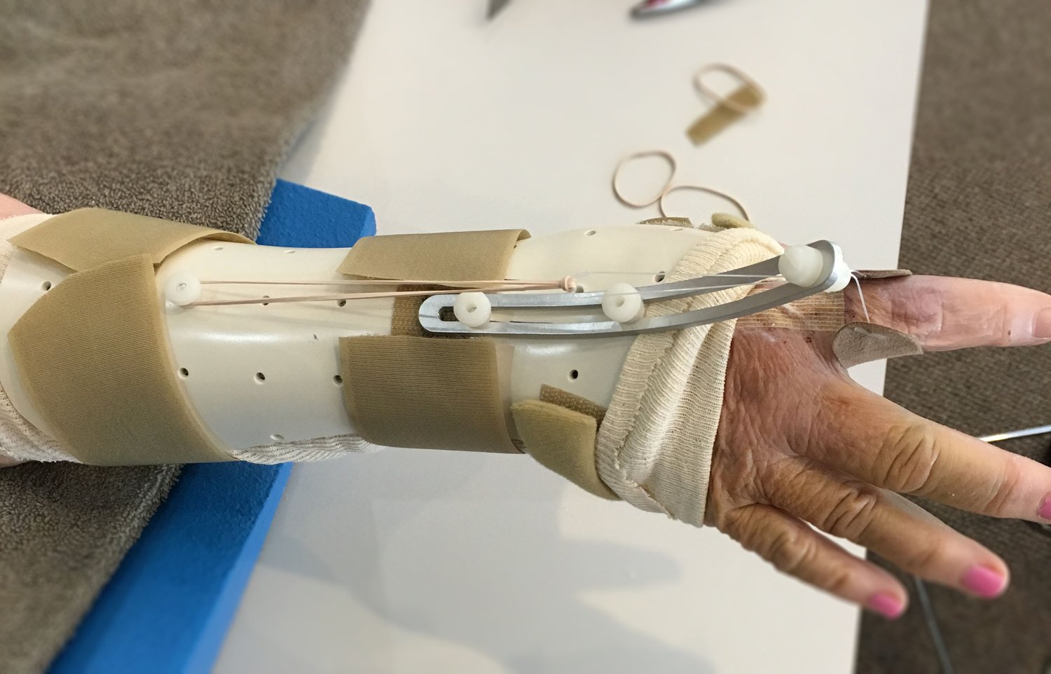 arm+2+horizontal Arm Injury
