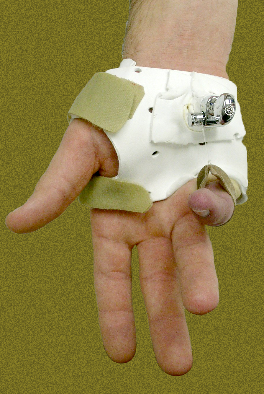 right+hand+green+background Hand Injury